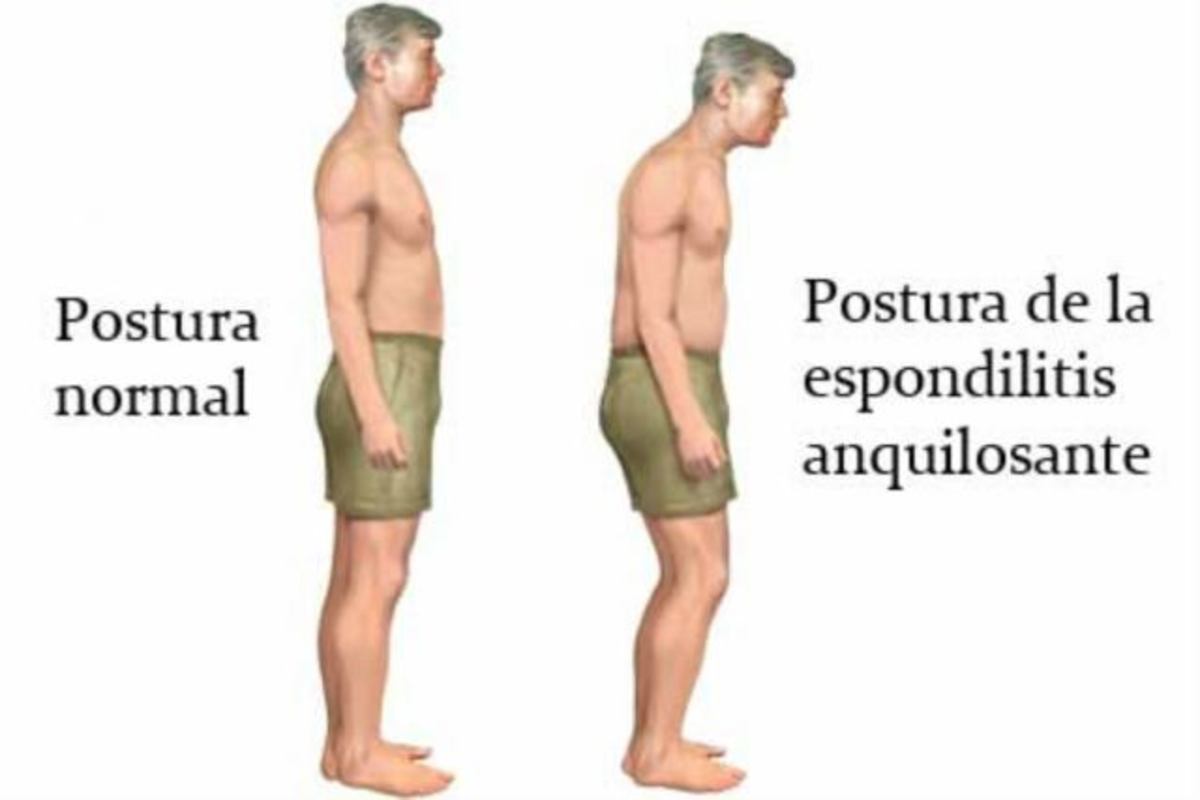 Espondilitis Anquilosante Causas síntomas y tratamiento