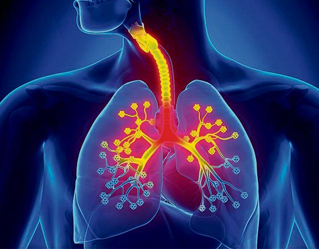 Bronquitis, causas y síntomas