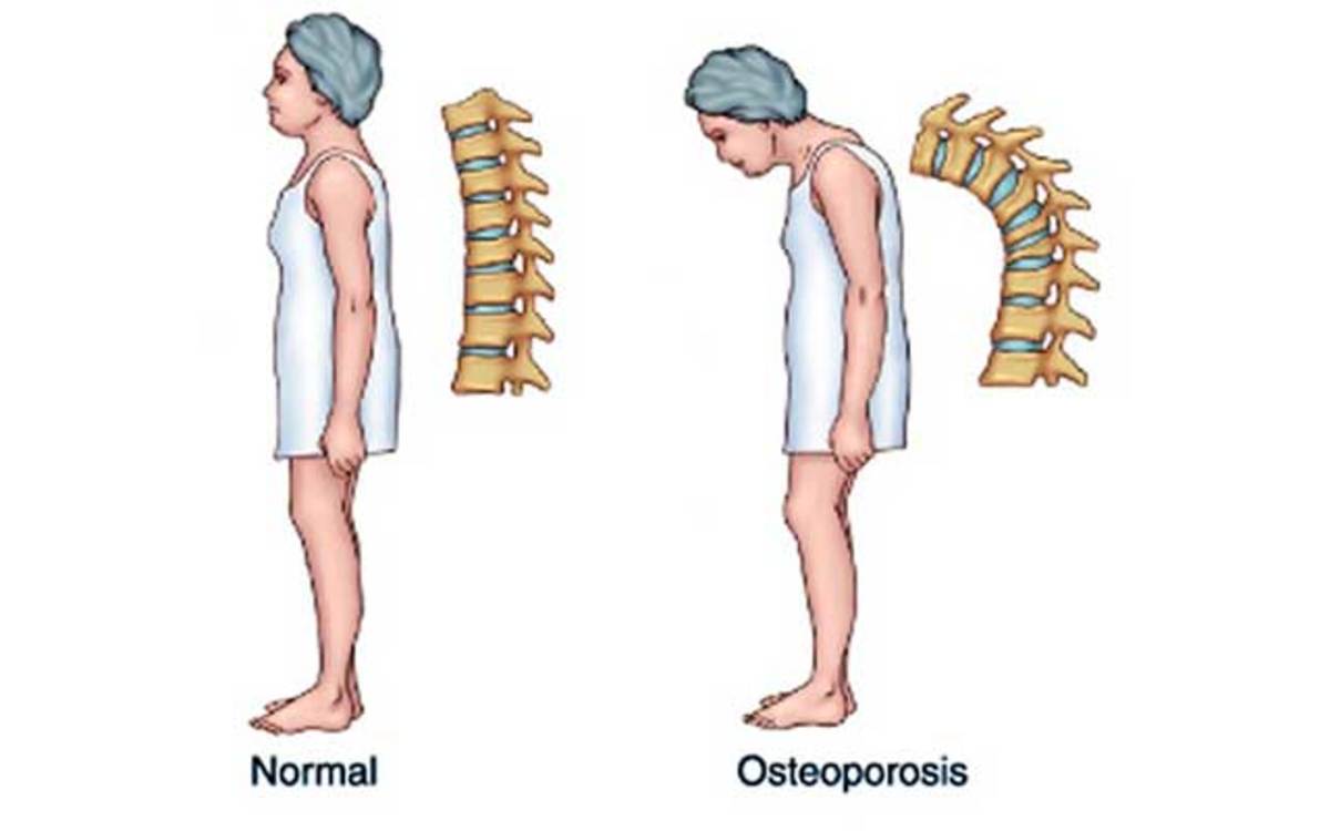 La Osteoporosis Tiene Tratamiento 7655