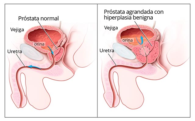 cáncer de próstata