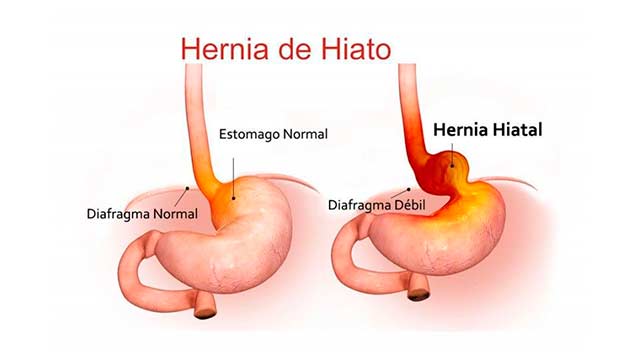 Hernia de hiato: qué es y como tratarla