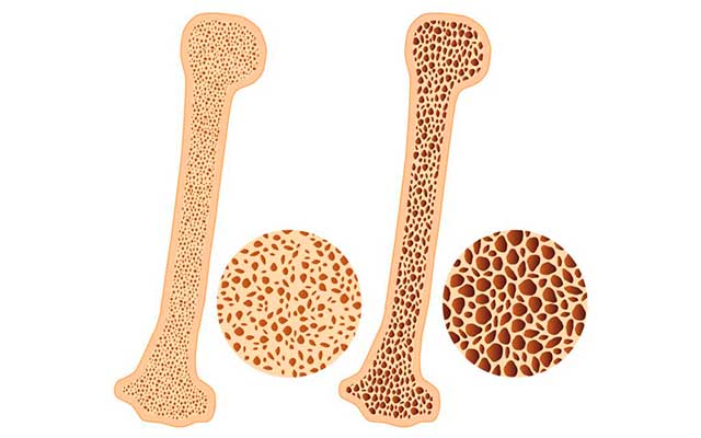 Como detectar la osteoporosis