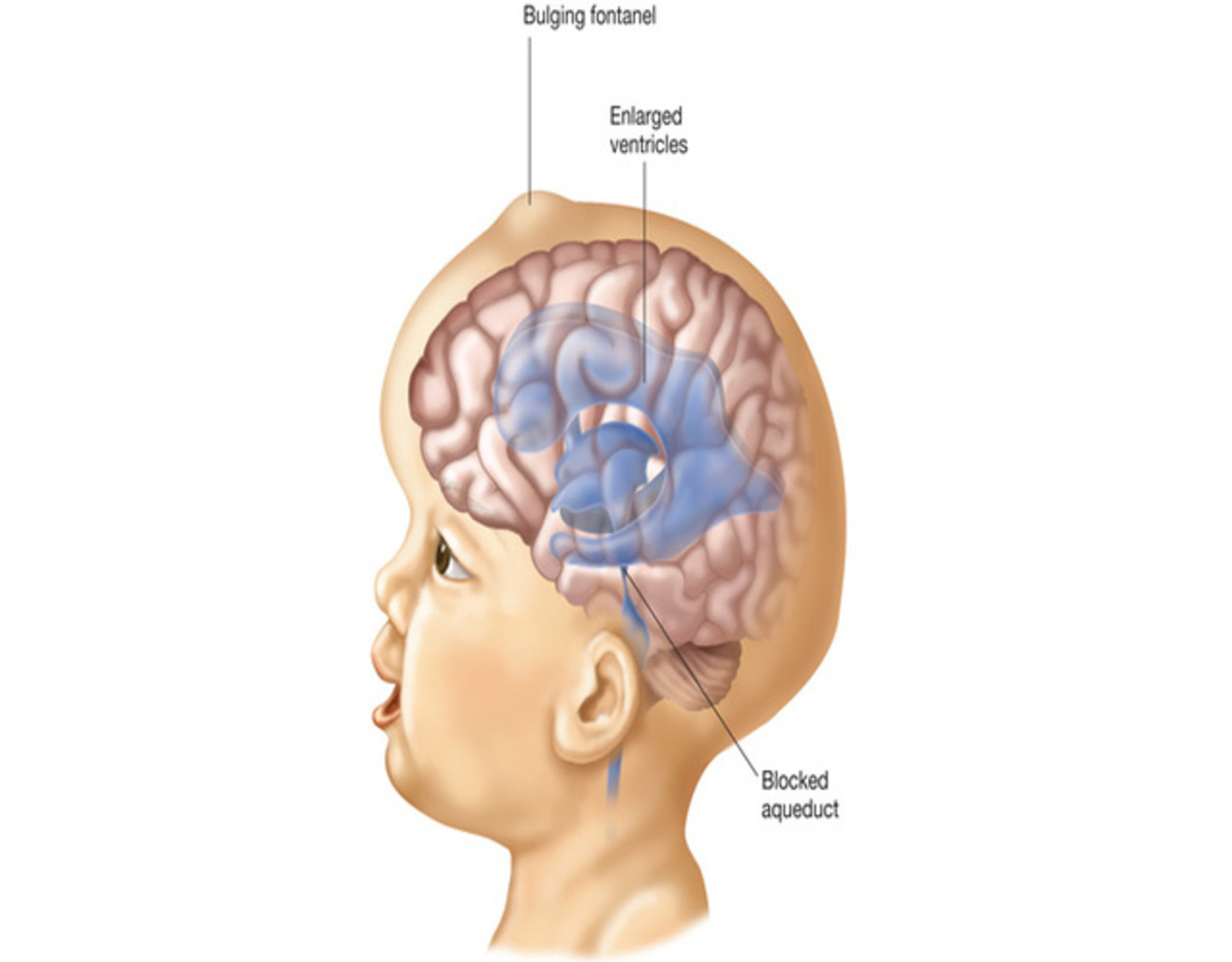 Hidrocefalia Síntomas Y Diagnóstico 4611