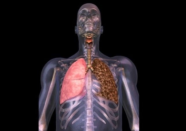 tratamientos del enfisema pulmonar
