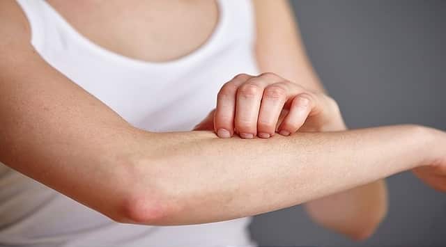 Dermatitis: Causas y remedios naturales