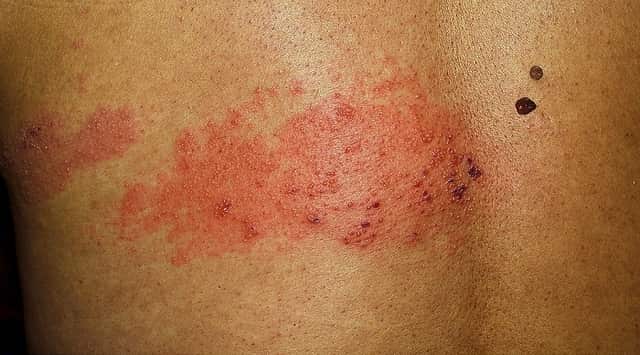 Dermatitis: Causas y remedios naturales