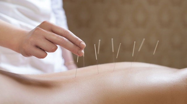 Beneficios de la acupuntura
