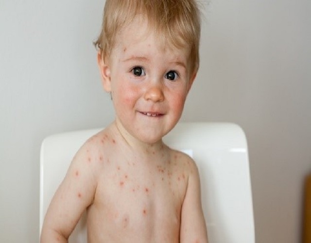 Síntomas de la varicela