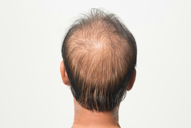 tratamientos para la alopecia