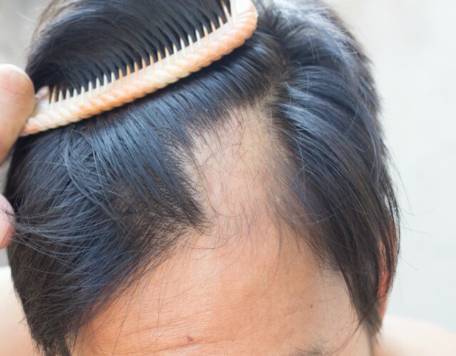 La alopecia o calvicie, es una de las enfermedades estéticas que más afecta emocionalmente a los hombres. Descubre los tratamientos para combatirla.