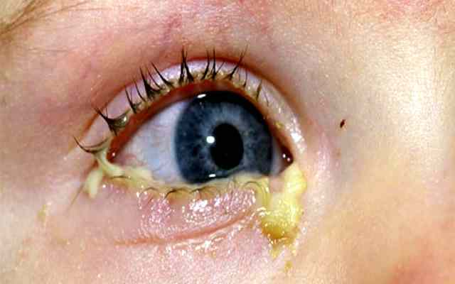 Causas comunes del dolor de ojos