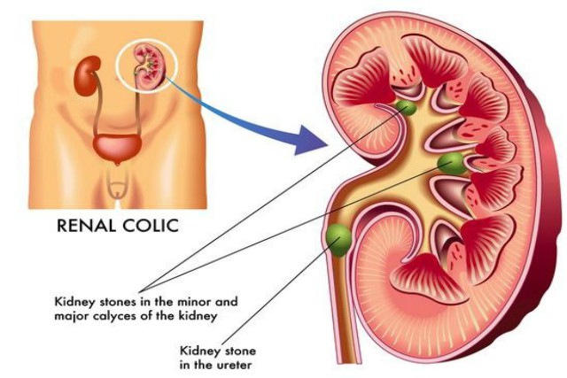 síntomas de cólico de riñón