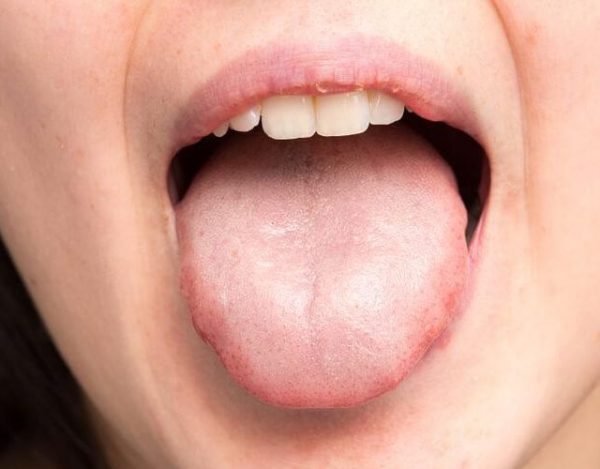 Hongos en la boca: síntomas y tratamientos