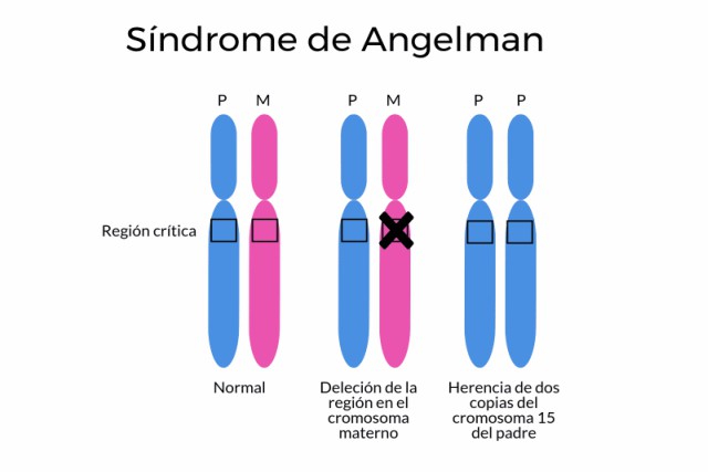 síndrome de angelman