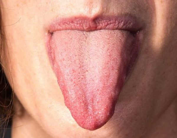 Cáncer de lengua: síntomas y tratamiento