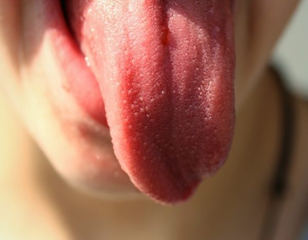 llagas en la lengua
