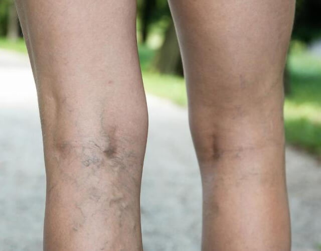 Varices en las piernas, porqué se producen y cómo tratarlas