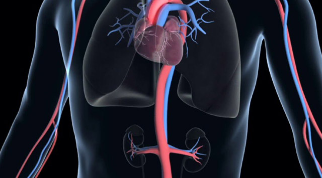 Aneurisma de aorta: causas y síntomas