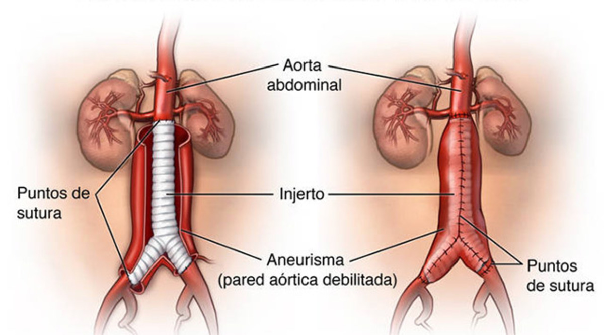 Аневризма аорты операция. Аневризма инфраренального отдела брюшной аорты. Аневризма брюшного отдела аорты. Аневризма брюшной аорты схема. Операция при аневризме брюшной аорты.