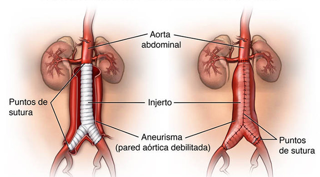 Aneurisma de aorta: causas y síntomas