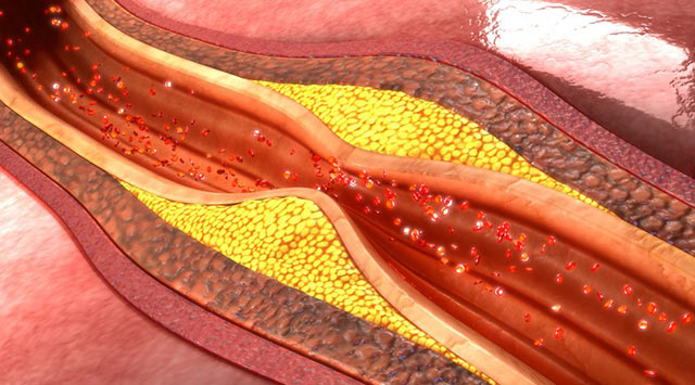 Arterioesclerosis: causas, síntomas y tratamiento