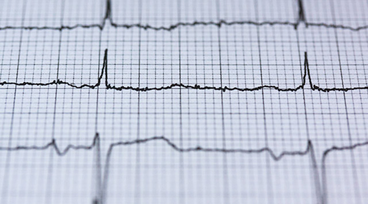 Electrocardiograma Qué Es Y Para Qué Sirve 5681