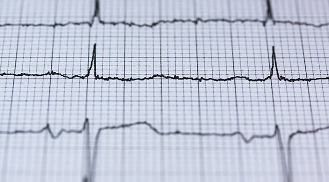 Electrocardiograma: qué es y para qué sirve