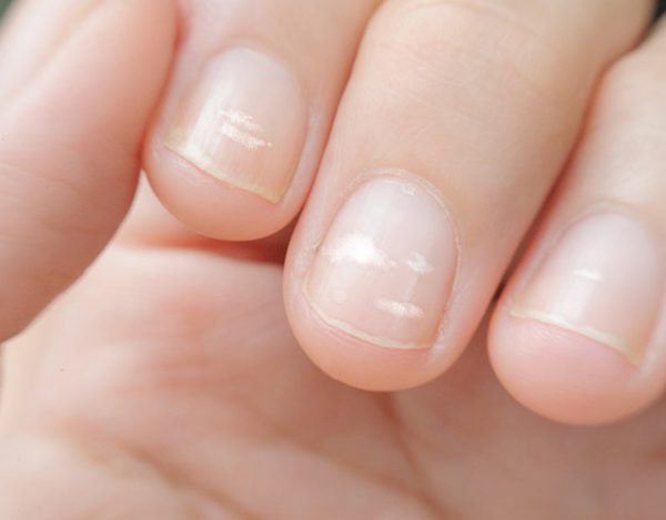 Manchas blancas en las uñas: causas y tratamiento