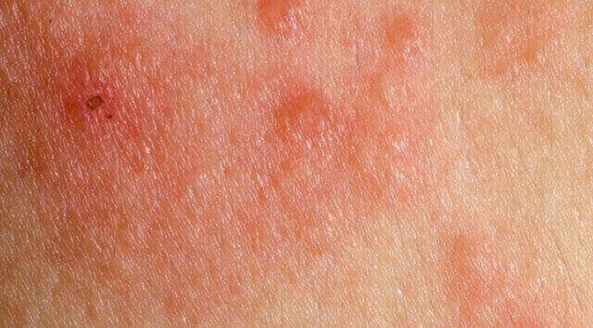 Micosis Fungoide S Ntomas Diagn Stico Y Tratamientos