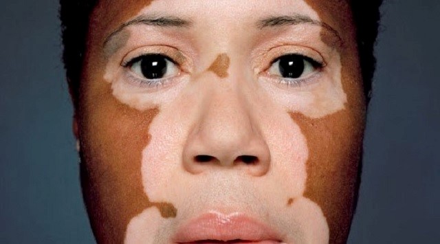 Trastornos de la pigmentación