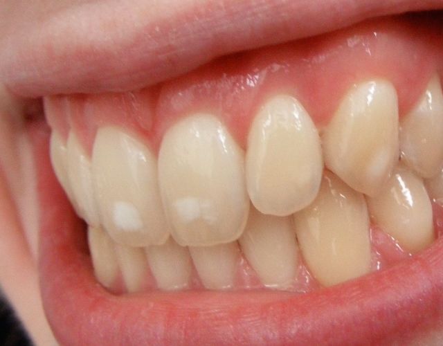 fluorosis dental