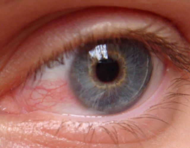 queratitis en los ojos